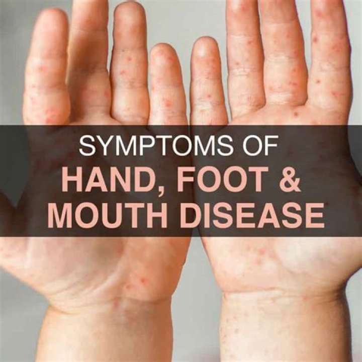 Can Hand Foot and mouth cause sores on face?