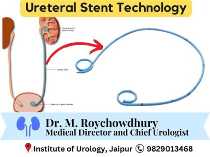 Can I exercise with ureteral stent?