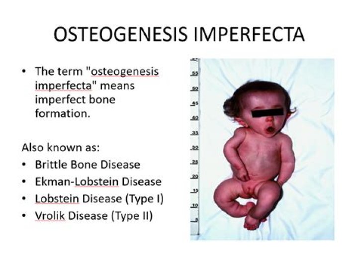What do you need to know about osteogenesis imperfecta?