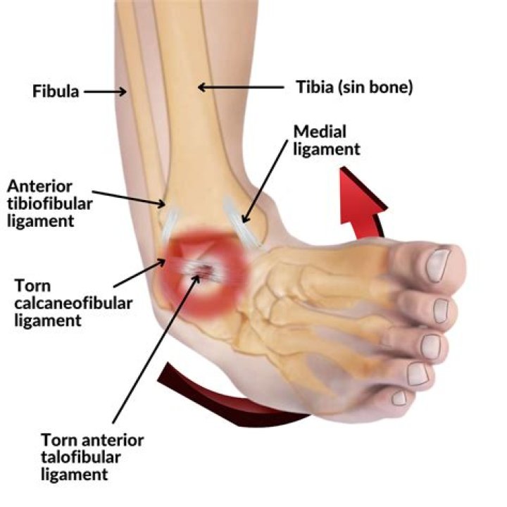 What is anterior inferior tibiofibular ligament?