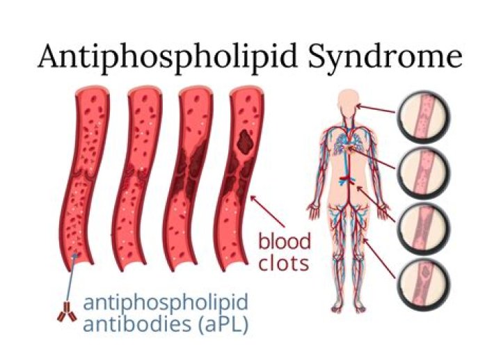 What is the normal range for antiphospholipid syndrome?